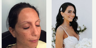 Eyebrow Transplant before and after photo