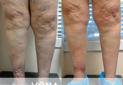 EVLT before and after photo