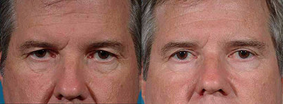 Eyelid Surgery before and after photo