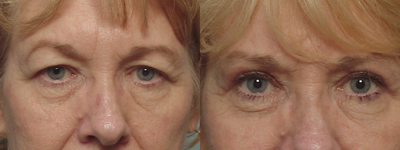 Eyelid Surgery before and after photo