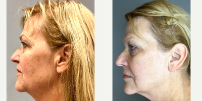 Halo Laser before and after photo