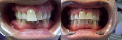 Invisalign before and after photo