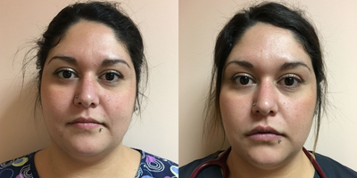 Juvederm before and after photo