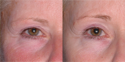 Ultherapy before and after photo