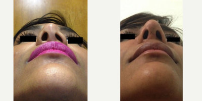 African American Rhinoplasty before and after photo