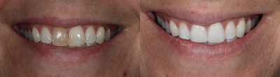 Dental Crown before and after photo