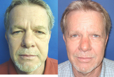 Eyelid Surgery before and after photo