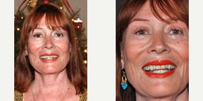 Lip Fillers before and after photo