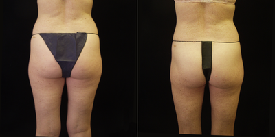 Liposuction before and after photo