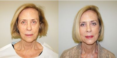 Mini Facelift before and after photo