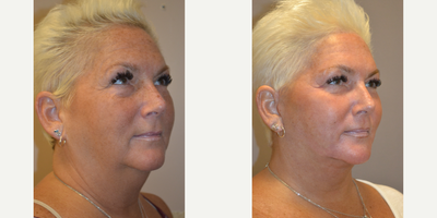 Neck Lift before and after photo