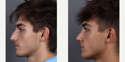 Rhinoplasty before and after photo