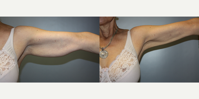 Smart Lipo before and after photo