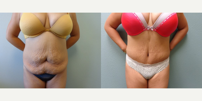 Tummy Tuck before and after photo