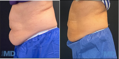 CoolSculpting before and after photo