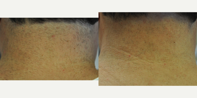 Laser Hair Removal before and after photo