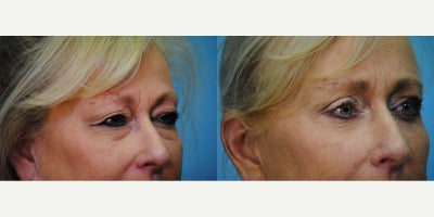 Brow Lift before and after photo
