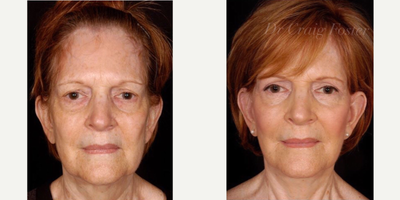 Eyelid Surgery before and after photo