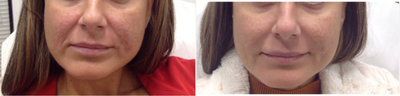 Juvederm before and after photo
