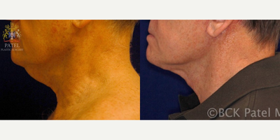 Neck Lift before and after photo