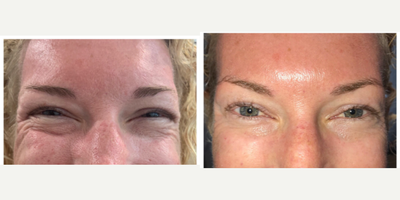 Botox before and after photo