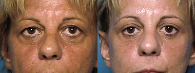 Eyelid Surgery before and after photo