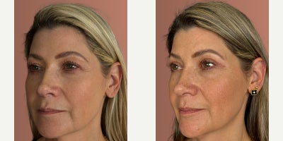 Eyelid Surgery before and after photo