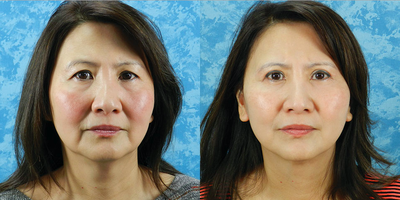 Facelift before and after photo