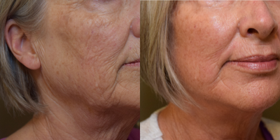 Facelift before and after photo