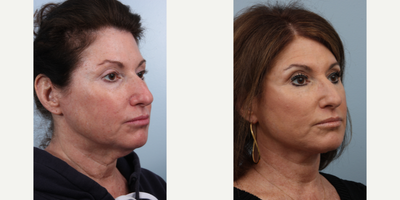 Facelift before and after photo