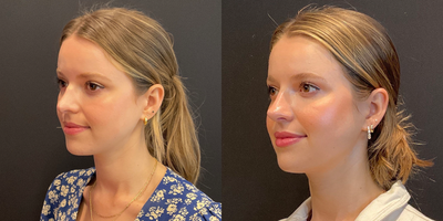 Revision Rhinoplasty before and after photo