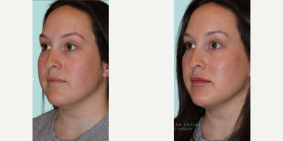 Botox before and after photo