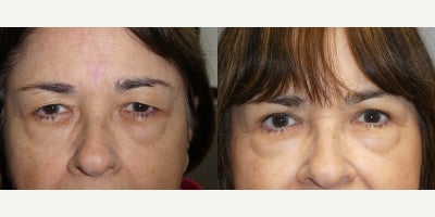 Eyelid Surgery before and after photo