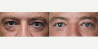 Eyelid Surgery before and after photo