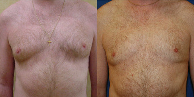 Gynecomastia Surgery before and after photo