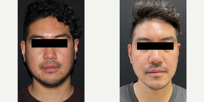 Skin Rejuvenation before and after photo