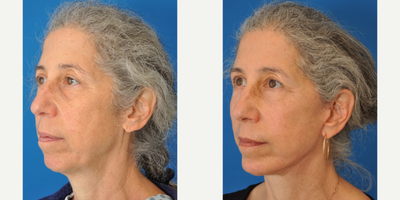 Facelift before and after photo