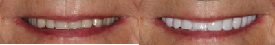 Smile Makeover before and after photo
