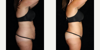 Tummy Tuck before and after photo