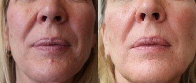 Mole Removal before and after photo