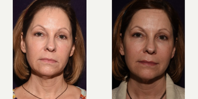 Skin Tightening before and after photo