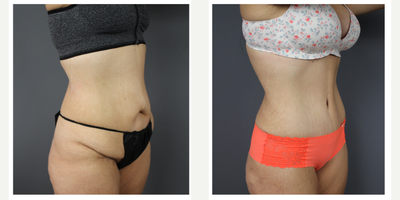 Tummy Tuck before and after photo