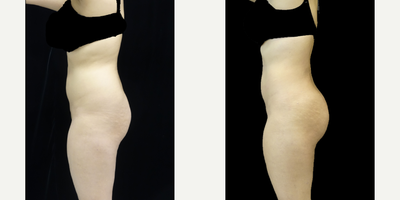 Butt Augmentation before and after photo