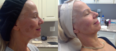 Laser Resurfacing before and after photo