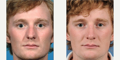 Rhinoplasty before and after photo