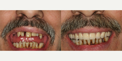 All-on-4 Dental Implants before and after photo