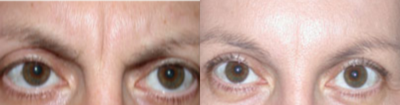 Botox before and after photo