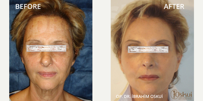 Facelift before and after photo