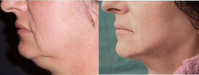 FaceTite before and after photo