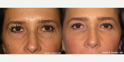 Facial Fat Transfer before and after photo